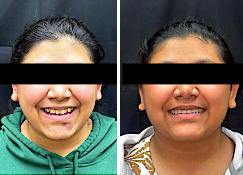 Invisalign in Manchester