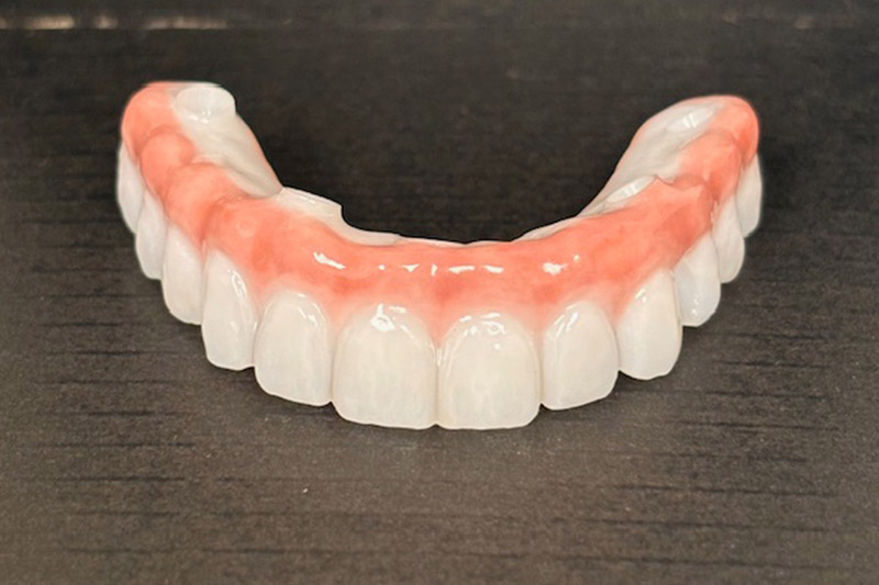 All on 4 Fixed Implant Hybrid Denture in Manchester