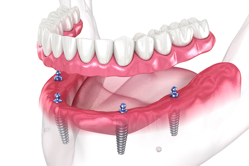 Complimentary Implant Consultation in Manchester