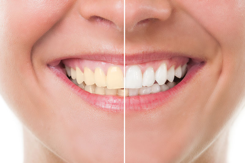 Teeth Whitening in Manchester