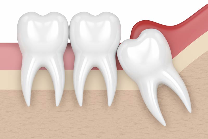 Wisdom Tooth Removal in Manchester